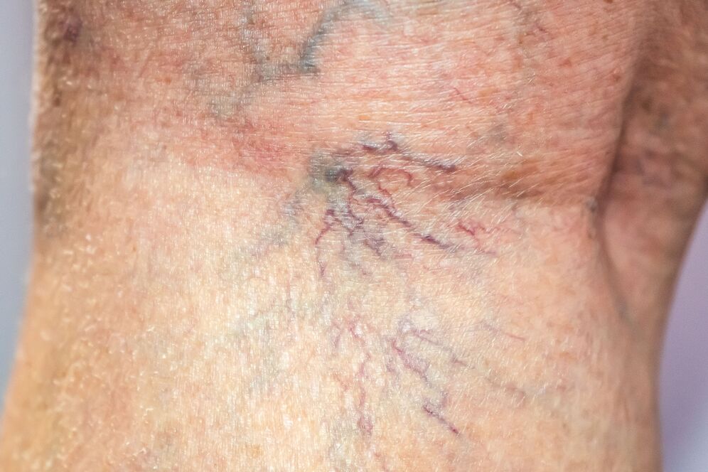 venas varicosas en el cuerpo