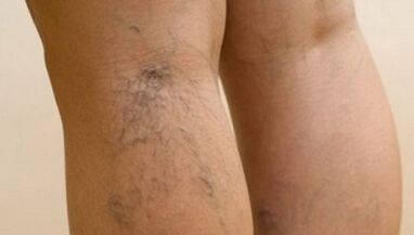 Las causas de las venas varicosas