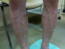 Venas varicosas en las piernas.