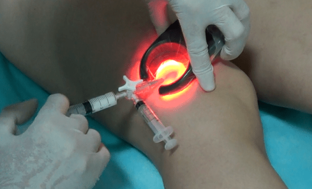 La escleroterapia es un método eficaz para tratar las venas varicosas en las piernas.
