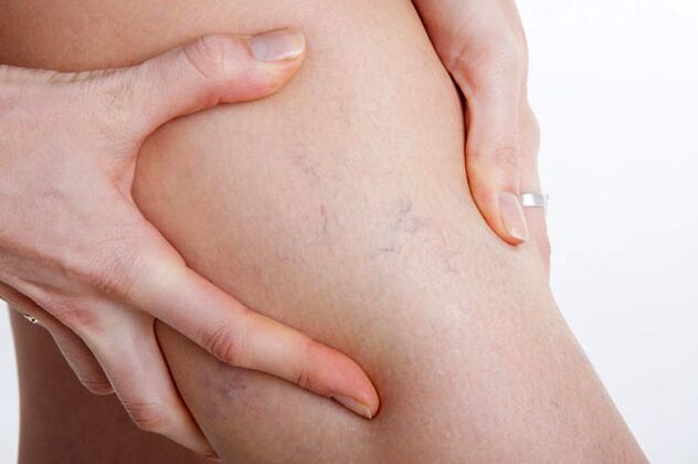 Las primeras apariciones de varices en la pierna.