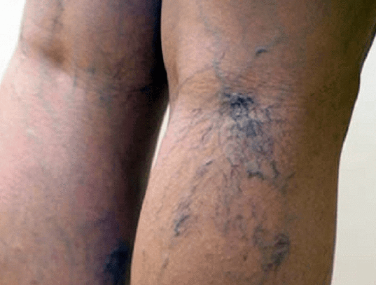 venas varicosas en las piernas